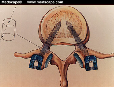 pedicle-screw pedicle-screw